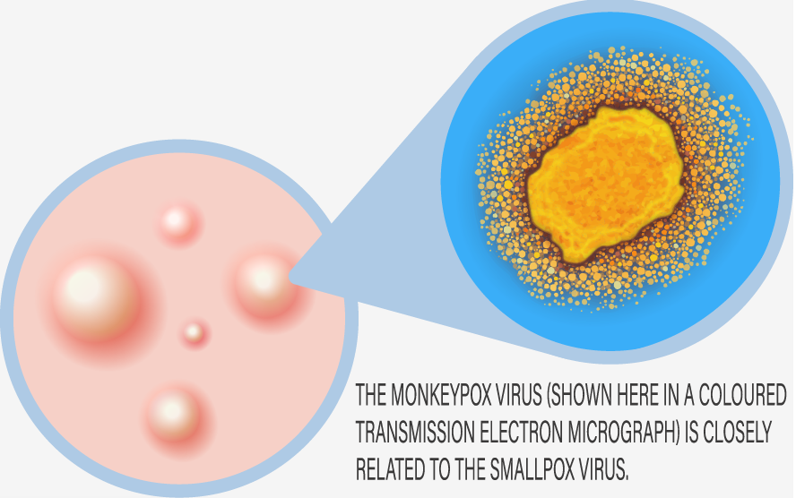 Monkeypox Virus Detection